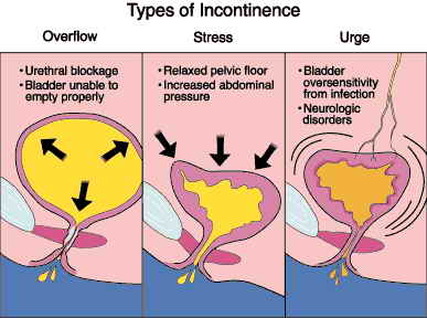 Inkontinensia urine adalah